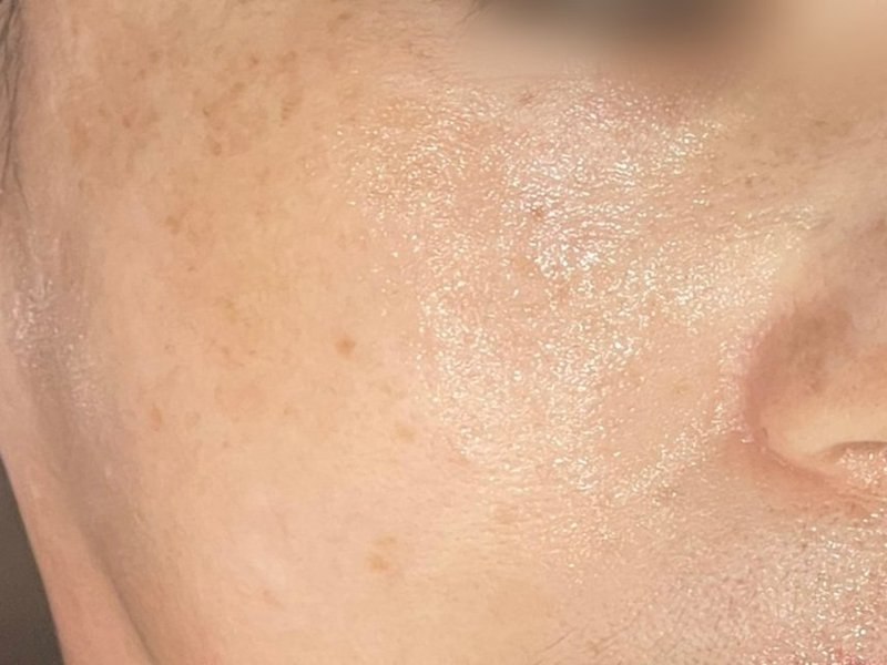 기미잡티 · 칙칙한 톤 관리 후 피부