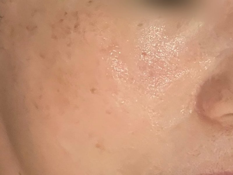 기미잡티 · 칙칙한 톤 관리 전 피부
