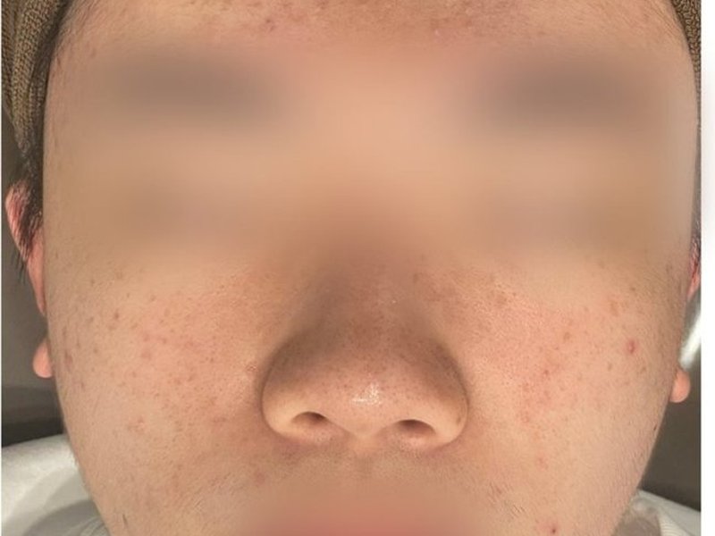 트러블 케어 관리 후 피부