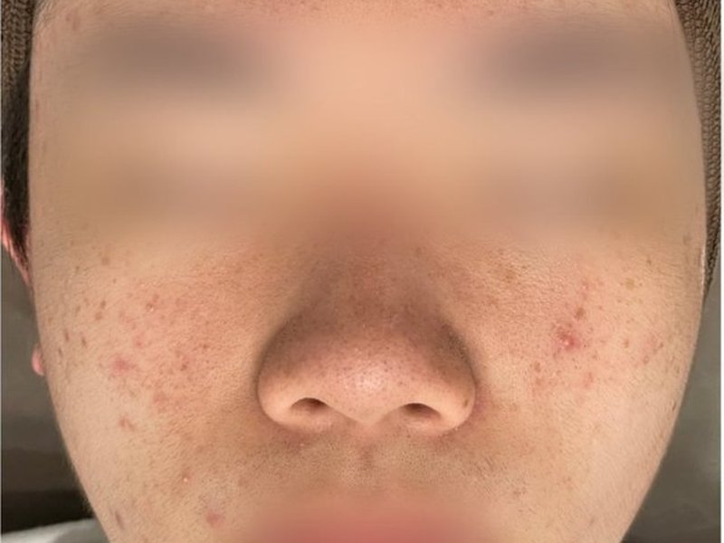 트러블 케어 관리 전 피부